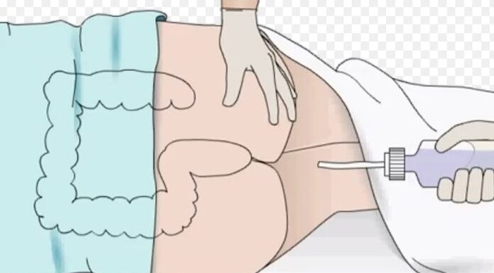 Enemas con plantas medicinales Enemas con plantas medicinales